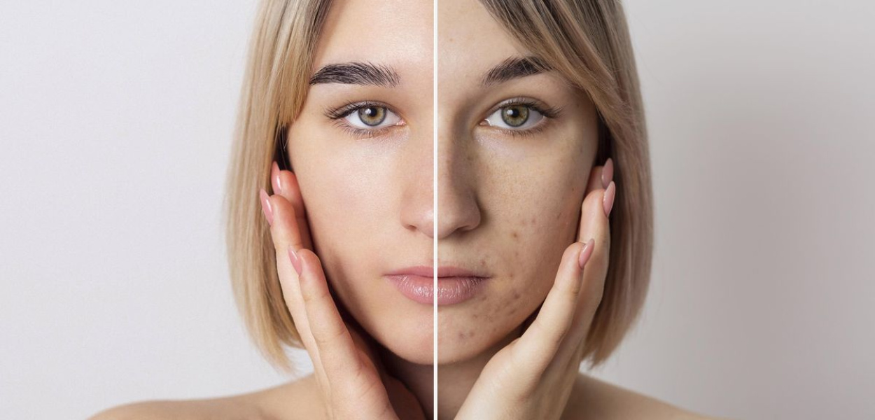 Sposoby na letnie przebawienia skóry